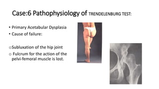 Case:6 Pathophysiology of TRENDELENBURG TEST:
• Primary Acetabular Dysplasia
• Cause of failure:
oSubluxation of the hip joint
o Fulcrum for the action of the
pelvi-femoral muscle is lost.
 