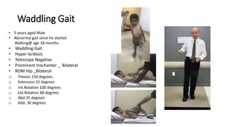 Waddling Gait
• 5 years aged Male
• Abnormal gait since he started
Walking@ age 18 months
• Waddling Gait
• Hyper lordosis
• Telescope Negative
• Prominent trochanter _ Bilateral
• ROM Hip _Bilateral
o Flexion 150 degrees
o Extension 15 degrees
o Int.Rotation 100 degrees
o Ext.Rotation 80 degrees
o Abd.35 degrees
o Add. 30 degrees
 