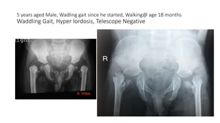 5 years aged Male, Wadling gait since he started, Walking@ age 18 months
Waddling Gait, Hyper lordosis, Telescope Negative
 