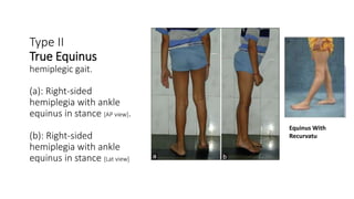 Type II
True Equinus
hemiplegic gait.
(a): Right-sided
hemiplegia with ankle
equinus in stance [AP view].
(b): Right-sided
hemiplegia with ankle
equinus in stance [Lat view]
Equinus With
Recurvatu
 