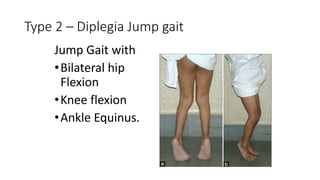 Type 2 – Diplegia Jump gait
Jump Gait with
•Bilateral hip
Flexion
•Knee flexion
•Ankle Equinus.
 