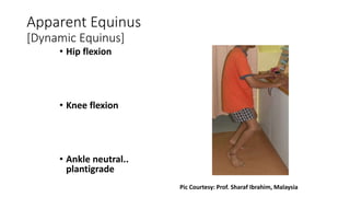 Apparent Equinus
[Dynamic Equinus]
• Hip flexion
• Knee flexion
• Ankle neutral..
plantigrade
Pic Courtesy: Prof. Sharaf Ibrahim, Malaysia
 