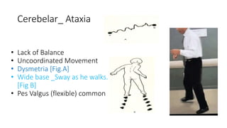 Cerebelar_ Ataxia
• Lack of Balance
• Uncoordinated Movement
• Dysmetria [Fig.A]
• Wide base _Sway as he walks.
[Fig B]
• Pes Valgus (flexible) common
 