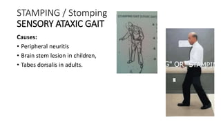STAMPING / Stomping
SENSORY ATAXIC GAIT
Causes:
• Peripheral neuritis
• Brain stem lesion in children,
• Tabes dorsalis in adults.
 