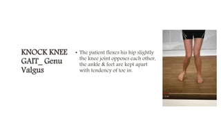 KNOCK KNEE
GAIT_ Genu
Valgus
• The patient flexes his hip slightly
the knee joint opposes each other,
the ankle & feet are kept apart
with tendency of toe in.
 