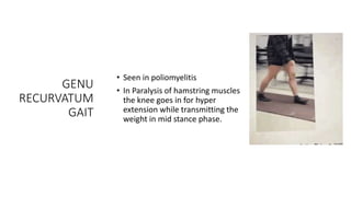 GENU
RECURVATUM
GAIT
• Seen in poliomyelitis
• In Paralysis of hamstring muscles
the knee goes in for hyper
extension while transmitting the
weight in mid stance phase.
 