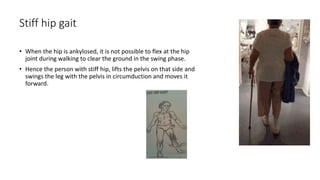 Stiff hip gait
• When the hip is ankylosed, it is not possible to flex at the hip
joint during walking to clear the ground in the swing phase.
• Hence the person with stiff hip, lifts the pelvis on that side and
swings the leg with the pelvis in circumduction and moves it
forward.
 