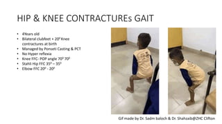 HIP & KNEE CONTRACTUREs GAIT
• 4Years old
• Bilateral clubfeet + 200 Knee
contractures at birth
• Managed by Ponseti Casting & PCT
• No Hyper reflexia
• Knee FFC- POP angle 700-700
• Stahli Hip FFC 350 – 350
• Elbow FFC 200 - 200
Gif made by Dr. Sadm baloch & Dr. Shahzaib@ZHC Clifton
 