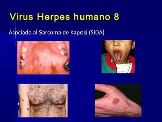 Virus Herpes humano 8Virus Herpes humano 8
Asociado al Sarcoma de Kaposi (SIDA)
 
