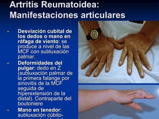4-artritis-reumatoides-cl-nica-ppt