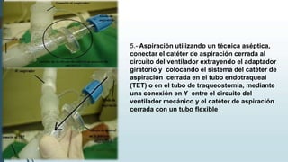 5.- Aspiración utilizando un técnica aséptica,
conectar el catéter de aspiración cerrada al
circuito del ventilador extrayendo el adaptador
giratorio y colocando el sistema del catéter de
aspiración cerrada en el tubo endotraqueal
(TET) o en el tubo de traqueostomía, mediante
una conexión en Y entre el circuito del
ventilador mecánico y el catéter de aspiración
cerrada con un tubo flexible
 