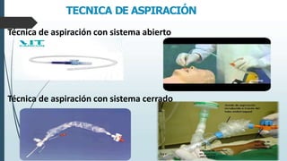 TECNICA DE ASPIRACIÓN
Técnica de aspiración con sistema abierto
Técnica de aspiración con sistema cerrado
 