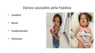 Danos causados pela hipóxia
• Cerebral
• Renal
• Cardiovascular
• Pulmonar
 
