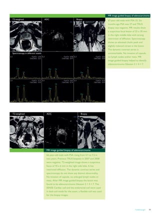 FieldStrength 11
T2-weighted ADC Biopsy
T2-weighted ADC Biopsy
Spectroscopy in different voxels
MR image guided biopsy of adenocarcinoma
66-year-old male with PSA rising from 5.1 to 7.2 in
two years. Previous TRUS biopsies in 2007 and 2008
were negative. T2-weighted image shows a suspicious
focus of 10 x 6 mm in the right side lobe. It has
restricted diffusion. The dynamic contrast series and
spectroscopy do not show any distinct abnormality.
No invasion of capsule, no enlarged lymph nodes or
mets. After MR image guided biopsy the lesion was
found to be adenocarcinoma Gleason 3 + 4 = 7. The
SENSE Cardiac coil and the endorectal coil were used
in dual-coil mode for the exam, a flexible coil was used
for the biopsy images.
MR image guided biopsy of adenocarcinoma
67-year-old male with PSA 33. Six
months ago PSA was 27 and TRUS
biopsy was negative. MR results show
a suspicious focal lesion of 25 x 30 mm
in the right middle lobe with strong
restriction of diffusion. Spectroscopy
shows an elevated cholin peak and
slightly reduced citrate in the lesion.
The dynamic contrast series is
unremarkable. No invasion of capsule,
no lymph nodes and/or mets. MR
image guided biopsy helped to identify
adenocarcinoma Gleason 3 + 4 = 7.
 