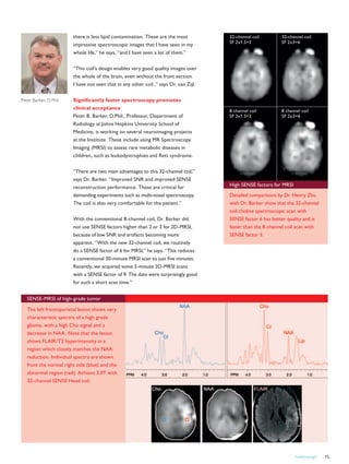 FieldStrength 15
there is less lipid contamination. These are the most
impressive spectroscopic images that I have seen in my
whole life,” he says, “and I have seen a lot of them.”
“This coil’s design enables very good quality images over
the whole of the brain, even without the front section.
I have not seen that in any other coil ,” says Dr. van Zijl.
Significantly faster spectroscopy promotes
clinical acceptance
Peter B. Barker, D.Phil., Professor, Department of
Radiology at Johns Hopkins University School of
Medicine, is working on several neuroimaging projects
at the Institute. These include using MR Spectroscopy
Imaging (MRSI) to assess rare metabolic diseases in
children, such as leukodystrophies and Rett syndrome.
“There are two main advantages to this 32-channel coil,”
says Dr. Barker. “Improved SNR and improved SENSE
reconstruction performance. These are critical for
demanding experiments such as multi-voxel spectroscopy.
The coil is also very comfortable for the patient.”
With the conventional 8-channel coil, Dr. Barker did
not use SENSE factors higher than 2 or 3 for 2D-MRSI,
because of low SNR and artifacts becoming more
apparent. “With the new 32-channel coil, we routinely
do a SENSE factor of 6 for MRSI,” he says. “This reduces
a conventional 30-minute MRSI scan to just five minutes.
Recently, we acquired some 3-minute 2D-MRSI scans
with a SENSE factor of 9. The data were surprisingly good
for such a short scan time.”
Peter Barker, D.Phil.
32-channel coil
SF 2x1.5=3
32-channel coil
SF 2x3=6
8 channel coil
SF 2x1.5=3
8 channel coil
SF 2x3=6
High SENSE factors for MRSI
Detailed comparisons by Dr. Henry Zhu
with Dr. Barker show that the 32-channel
coil choline spectroscopic scan with
SENSE factor 6 has better quality and is
faster than the 8-channel coil scan with
SENSE factor 3.
SENSE-MRSI of high-grade tumor
The left frontoparietal lesion shows very
characteristic spectra of a high grade
glioma, with a high Cho signal and a
decrease in NAA. Note that the lesion
shows FLAIR/T2 hyperintensity in a
region which closely matches the NAA
reduction. Individual spectra are shown
from the normal right side (blue) and the
abnormal region (red). Achieva 3.0T with
32-channel SENSE Head coil.
 