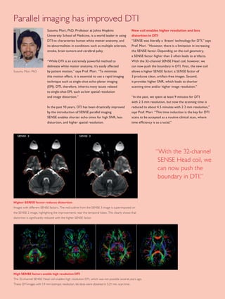 FieldStrength – Issue 39 – December 200916
Susumu Mori, PhD, Professor at Johns Hopkins
University School of Medicine, is a world leader in using
DTI to characterize human white matter anatomy, and
its abnormalities in conditions such as multiple sclerosis,
stroke, brain tumors and cerebral palsy.
“While DTI is an extremely powerful method to
delineate white matter anatomy, it’s easily affected
by patient motion,” says Prof. Mori. “To minimize
this motion effect, it is essential to use a rapid imaging
technique such as single-shot echo-planar imaging
(EPI). DTI, therefore, inherits many issues related
to single-shot EPI, such as low spatial resolution
and image distortion.”
In the past 10 years, DTI has been drastically improved
by the introduction of SENSE parallel imaging.
SENSE enables shorter echo times for high SNR, less
distortion, and higher spatial resolution.
New coil enables higher resolution and less
distortion in DTI
“SENSE was literally a ‘dream’ technology for DTI,” says
Prof. Mori. “However, there is a limitation in increasing
the SENSE factor. Depending on the coil geometry,
a SENSE factor higher than 2 often leads to artifacts.
With the 32-channel SENSE Head coil, however, we
can now push the boundary in DTI. First, the new coil
allows a higher SENSE factor; a SENSE factor of
3 produces clean, artifact-free images. Second,
it provides higher SNR, which leads to shorter
scanning time and/or higher image resolution.”
“In the past, we spent at least 9 minutes for DTI
with 2.5 mm resolution, but now the scanning time is
reduced to about 4.5 minutes with 2.2 mm resolution,”
says Prof. Mori. “This time reduction is the key for DTI
scans to be accepted as a routine clinical scan, where
time efficiency is so crucial.”
Susumu Mori, PhD
SENSE 2 SENSE 3
“With the 32-channel
SENSE Head coil, we
can now push the
boundary in DTI.”
Parallel imaging has improved DTI
Higher SENSE factor reduces distortion
Images with different SENSE factors. The red outline from the SENSE 3 image is superimposed on
the SENSE 2 image, highlighting the improvements near the temporal lobes. This clearly shows that
distortion is significantly reduced with the higher SENSE factor.
High SENSE factors enable high resolution DTI
The 32-channel SENSE Head coil enables high resolution DTI, which was not possible several years ago.
These DTI images with 1.9 mm isotropic resolution, 66 slices were obtained in 5:21 min. scan time.
 