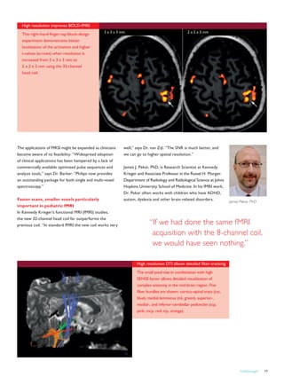 FieldStrength 17
High resolution improves BOLD-fMRI
This right-hand finger-tap block-design
experiment demonstrates better
localization of the activation and higher
t-values (arrows) when resolution is
increased from 3 x 3 x 3 mm to
2 x 2 x 2 mm using the 32-channel
head coil.
“If we had done the same fMRI
acquisition with the 8-channel coil,
we would have seen nothing.”
3 x 3 x 3 mm 2 x 2 x 2 mm
The applications of MRSI might be expanded as clinicians
become aware of its feasibility. “Widespread adoption
of clinical applications has been hampered by a lack of
commercially available optimized pulse sequences and
analysis tools,” says Dr. Barker. “Philips now provides
an outstanding package for both single and multi-voxel
spectroscopy.”
Faster scans, smaller voxels particularly
important in pediatric fMRI
In Kennedy Krieger’s functional MRI (fMRI) studies,
the new 32-channel head coil far outperforms the
previous coil. “In standard fMRI the new coil works very
well,” says Dr. van Zijl. “The SNR is much better, and
we can go to higher spatial resolution.”
James J. Pekar, PhD, is Research Scientist at Kennedy
Krieger and Associate Professor in the Russel H. Morgan
Department of Radiology and Radiological Science at Johns
Hopkins University School of Medicine. In his fMRI work,
Dr. Pekar often works with children who have ADHD,
autism, dyslexia and other brain-related disorders. James Pekar, PhD
High resolution DTI allows detailed fiber-tracking
The small pixel size in combination with high
SENSE factor allows detailed visualization of
complex anatomy in the mid-brain region. Five
fiber bundles are shown: cortico-spinal tract (cst,
blue), medial lemniscus (ml, green), superior-,
medial-, and inferior-cerebellar peduncles (scp,
pink; mcp, red; icp, orange).
 