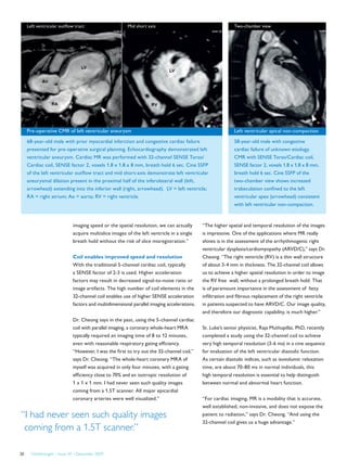 FieldStrength – Issue 39 – December 200920
Two-chamber view
Left ventricular apical non-compaction
58-year-old male with congestive
cardiac failure of unknown etiology.
CMR with SENSE Torso/Cardiac coil,
SENSE factor 2, voxels 1.8 x 1.8 x 8 mm,
breath hold 6 sec. Cine SSFP of the
two-chamber view shows increased
trabeculation confined to the left
ventricular apex (arrowhead) consistent
with left ventricular non-compaction.
imaging speed or the spatial resolution, we can actually
acquire multislice images of the left ventricle in a single
breath hold without the risk of slice misregistration.”
Coil enables improved speed and resolution
With the traditional 5-channel cardiac coil, typically
a SENSE factor of 2-3 is used. Higher acceleration
factors may result in decreased signal-to-noise ratio or
image artifacts. The high number of coil elements in the
32-channel coil enables use of higher SENSE acceleration
factors and multidimensional parallel imaging accelerations.
Dr. Cheong says in the past, using the 5-channel cardiac
coil with parallel imaging, a coronary whole-heart MRA
typically required an imaging time of 8 to 12 minutes,
even with reasonable respiratory gating efficiency.
“However, I was the first to try out the 32-channel coil,”
says Dr. Cheong. “The whole-heart coronary MRA of
myself was acquired in only four minutes, with a gating
efficiency close to 70% and an isotropic resolution of
1 x 1 x 1 mm. I had never seen such quality images
coming from a 1.5T scanner. All major epicardial
coronary arteries were well visualized.”
“I had never seen such quality images
coming from a 1.5T scanner.”
“The higher spatial and temporal resolution of the images
is impressive. One of the applications where MR really
shines is in the assessment of the arrhythmogenic right
ventricular dysplasia/cardiomyopathy (ARVD/C),” says Dr.
Cheong. “The right ventricle (RV) is a thin wall structure
of about 3-4 mm in thickness. The 32-channel coil allows
us to achieve a higher spatial resolution in order to image
the RV free wall, without a prolonged breath hold. That
is of paramount importance in the assessment of fatty
infiltration and fibrous replacement of the right ventricle
in patients suspected to have ARVD/C. Our image quality,
and therefore our diagnostic capability, is much higher.”
St. Luke’s senior physicist, Raja Muthupillai, PhD, recently
completed a study using the 32-channel coil to achieve
very high temporal resolution (3-6 ms) in a cine sequence
for evaluation of the left ventricular diastolic function.
As certain diastolic indices, such as isovolumic relaxation
time, are about 70-80 ms in normal individuals, this
high temporal resolution is essential to help distinguish
between normal and abnormal heart function.
“For cardiac imaging, MR is a modality that is accurate,
well established, non-invasive, and does not expose the
patient to radiation,” says Dr. Cheong. “And using the
32-channel coil gives us a huge advantage.”
Left ventricular outflow tract Mid short axis
Pre-operative CMR of left ventricular aneurysm
68-year-old male with prior myocardial infarction and congestive cardiac failure
presented for pre-operative surgical planning. Echocardiography demonstrated left
ventricular aneurysm. Cardiac MR was performed with 32-channel SENSE Torso/
Cardiac coil, SENSE factor 2, voxels 1.8 x 1.8 x 8 mm, breath hold 6 sec. Cine SSFP
of the left ventricular outflow tract and mid short-axis demonstrate left ventricular
aneurysmal dilation present in the proximal half of the inferolateral wall (left,
arrowhead) extending into the inferior wall (right, arrowhead). LV = left ventricle;
RA = right atrium; Ao = aorta; RV = right ventricle.
 