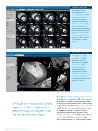 FieldStrength – Issue 39 – December 200922
Dobutamine stress study
Synchronized display of
multiple cine short axis
views of a dobutamine CMR
stress study. From left to
right: increasing levels of
graded dobutamine dosage.
From top to bottom: basal,
equatorial and apical short
axis orientation. Missing wall
thickening of the inferolateral
segment in all three short
axis views under maximum
dobutamine stress can easily
be recognized to assist in
diagnosis.
Targeted RCA reconstruction
Vessel Explorer used for
reconstruction of a 3D
whole-heart coronary
MR angiography. Targeted
reconstruction of the
right coronary artery
(RCA) is exemplified
using maximum intensity
projection, multiplanar
curved reformatting and
corresponding cross-sectional
view of RCA lumen.
“With just two mouse clicks Cardiac
Explorer displays multiple views at
different stress levels together with
the non-cine dynamic images.”
Vessel Explorer helps evaluate coronary arteries
Vessel Explorer not only facilitates 3D reconstruction of
large thoracic or mid-sized peripheral arteries, but also
of the coronary arteries with 2 to 4 mm luminal diameter
range. “The benefits of Vessel Explorer are enormous,”
says Dr. Paetsch. “Interactive and simultaneous display
of 3D volume rendering, MIPs and MPRs ensures
easier anatomical identification of complex vessel
anatomy and speeds up path identification for additional
reconstructions highlighting a specific pathology.
Several vessel parameters are simultaneously provided
 