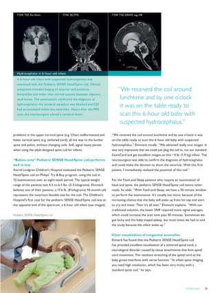 FieldStrength 25
problems in the upper cervical spine (e.g. Chiari malformation) and
lower cervical spine (e.g. tethered cord), all the way to the lumbar
spine and pelvis, without changing coils. Still, signal issues persist
when using the adult-designed spine coil for infants.
“Babies-only” Pediatric SENSE Head/Spine coil performs
well in test
Astrid Lindgren Children’s Hospital evaluated the Pediatric SENSE
Head/Spine coil on Philips’ Try  Buy program, using the coil in
12 examinations over an eight-week period. The typical weight
range of the patients was 4.5 to 6.5 lbs. (2-3 kilograms). Ehnmark
believes one of their patients, a 17.6 lb. (8 kilograms) 10-month-old
represents the maximum feasible size for the coil. The Children’s
Hospital’s first case for the pediatric SENSE Head/Spine coil was at
the opposite end of the spectrum, a 6-hour old infant (see images).
“We received the coil around lunchtime and by one o’clock it was
on the table ready to scan this 6-hour old baby with suspected
hydrocephalus,” Ehnmark recalls. “We obtained really nice images. It
was very impressive that we could just plug the coil in, run our standard
ExamCard and get excellent images on this ~4 lb. (1.9 kg) infant. The
neurosurgeon was able to confirm the diagnosis of hydrocephalus
and could make the decision to shunt the ventricle. With this first
patient, I immediately realized the potential of this coil.”
For the Feed-and-Sleep patients who require an examination of
head and spine, the pediatric SENSE Head/Spine coil seems tailor-
made, he adds. “With Feed-and-Sleep, we have a 30-minute window
to perform the examination. It’s usually not more, because of the
increasing chance that the baby will wake up from his nap and start
to cry and move. Then it’s all over,” Ehnmark explains. “With our
traditional solution, the lower SNR required more signal averages,
which could increase the scan time past 30 minutes. Sometimes we
got lucky and the baby stayed asleep, but most times we had to end
the study because the infant woke up.”
Clear visualization of congenital anomalies
Ehmark has found that the Pediatric SENSE Head/Spine coil
has provided excellent visualization of a tethered spinal cord, a
neurological disorder caused by tissue attachments that limit spinal
cord movement. The resultant stretching of the spinal cord as the
baby grows interferes with nerve function. “In infant spine imaging,
you need high resolution, which has been very tricky with a
standard spine coil,” he says.
“We received the coil around
lunchtime and by one o’clock
it was on the table ready to
scan this 6-hour old baby with
suspected hydrocephalus.”
T2W TSE Ax 4mm T1W 3D FFE T2W TSE DRIVE sag HR
Hydrocephalus in 6-hour-old infant
A 6-hour-old infant with suspected hydrocephalus was
examined with the Pediatric SENSE Head/Spine coil. Clinical
symptoms included bulging of anterior and posterior
fontanelles and wider than normal sutures between adjacent
skull bones. The examination confirmed the diagnosis of
hydrocephalus; the cerebral aqueduct was blocked and CSF
had accumulated within the ventricles. Hours after the MRI
scan, the neurosurgeon placed a cerebral shunt.
Pediatric SENSE Head/Spine coil
 