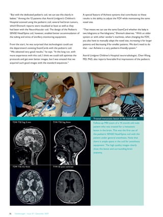 FieldStrength – Issue 39 – December 200926
“But with the dedicated pediatric coil, we can see this clearly in
babies.” Among the 12 patients that Astrid Lindgren’s Children’s
Hospital scanned using the pediatric coil, several had brain tumors,
which Ehnmark reports were visualized at least as well as they
had been with the NeuroVascular coil. The design of the Pediatric
SENSE Head/Spine coil, however, enabled better accommodation of
the tubing and wires of ancillary monitoring equipment.
From the start, he was surprised that technologists could use
the department’s existing ExamCards with the pediatric coil.
“We obtained very good results,” he says. “In the long run, with
more experience with this coil, I think we could still optimize the
protocols and get even better images, but I was amazed that we
acquired such good images with the standard sequences.”
A special feature of Achieva systems that contributes to these
results is the ability to adjust the FOV while maintaining the same
voxel size.
“That means we can use the same ExamCard whether the baby is
two kilograms or five kilograms,” Ehnmark observes. “With an older
system or with other vendor’s machines, when changing the FOV,
you also have to manually adapt the voxel size, increasing it for larger
patients and decreasing if for smaller patients. We don’t need to do
that – our Achieva is a very pediatric-friendly system.”
Astrid Lindgren Children’s Hospital neuroradiologist, Chen Wang,
MD, PhD, also reports favorable first impressions of the pediatric
T2W TSE Sag 3 mm T1W TSE Sag 4mm
T2W TSE Ax 4mm T1W SE post contrast
Treated metastatic lesion in 14-month-old
Follow-up MRI exam of a 14-month-old male
patient who was treated for a metastatic
lesion in the brain. This was the first use of
the pediatric SENSE Head/Spine coil with the
patient under general anesthesia. Note that
there is ample space in the coil for anesthesia
equipment. The high quality images clearly
show the lesion and surrounding brain
anatomy.
 