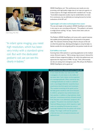 FieldStrength 27
Intraspinal extension, tethered cord in 2-week-old
A two-week-old infant was referred for MRI
investigation of a skin lesion in the midline of
the lower back. Such a lesion can be suspicious
of a meningomyelocele. Often covered by skin,
a meningomyelocele can result in a tethered
cord, a neurological disorder caused by tissue
attachments that limit spinal cord movement.
The resultant stretching of the spinal cord as
the baby grows interferes with nerve function.
In children, symptoms may include lesions and
hairy patches, in addition to leg weakness, lower
back pain, incontinence and loss of bowel control.
If the disorder is not addressed, symptoms will
progress. The patient was examined using the
Feed-and-Sleep protocol, which requires a rapid
study not exceeding 30 minutes (to ensure a
reasonable likelihood that the patient will remain
asleep). The images confirmed the question
of dermal sinus with intraspinal extension and
tethered cord.
SENSE Head/Spine coil. “Our preliminary test results are very
promising, with high quality images that to our eyes are superior, or
at least equal to, the images obtained with a standard coil,” he says.
“Controlled comparative studies may be needed before we make
firm conclusions, but we definitely are looking forward to further
evaluations of this RF coil.”
Lightweight coil makes technologists lives easier
The size and weight of the pediatric SENSE Head/Spine coil makes
it very easy to use, according to Ehnmark. “The pediatric coil seems
to weigh almost nothing,” he says. “Some of the other coils are
noticeably heavier.”
The Pediatric SENSE Head/Spine coil comes with a special mattress
that enables precise positioning of the coil centered on the patient
table. The mattress’s thickness brings it flush to the part of the coil
on which the patient lays, allowing technologists to wrap the baby in a
blanket outside the coil and gently pull him into position inside the coil.
Coil fulfills a real need
Scanning these infant patients is a growing application at the medical
center, Ehnmark reports. “We’re seeing a big increase in demand for
studies of these congenital problems, for which the pediatricians can
appreciate the importance of MRI,” he says. “And, unfortunately,
we also are seeing more emergency cases. We will put the Pediatric
SENSE Head/Spine coil to good use.”
Chen Wang, MD, PhD
“In infant spine imaging, you need
high resolution, which has been
very tricky with a standard spine
coil. But with the dedicated
pediatric coil, we can see this
clearly in babies.”
 