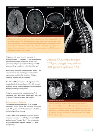 FieldStrength 29
“In patients with rectal cancer, it is essential to
differentiate stage T2 from stage T3, the latter involving
invasion of surrounding fatty tissue,” he says. “T2
patients normally are resected immediately, while T3
patients undergo neoadjuvant radio-chemotherapy.”
Better spatial resolution in breast MRI has yielded 1 mm
reconstructions, Prof. Helmberger adds. In addition,
higher spatial resolution has benefitted MRA and
imaging of the joints and the cerebrum.
The Achieva XR system’s more robust gradients also
have enabled DOH to scan faster, with a 20% increase
in patients per day from 10-15 patients to 12-18 patients
during normal daily scanning hours.
Finally, fat suppression has been exceptional, Prof.
Helmberger says, “which is not unusual, since that is one
of the stars in the entire Philips MRI portfolio.”
An investment in the future
Prof. Helmberger regards Achieva XR as the ideal
solution for medical centers that are strictly limited to a
single MRI system, but which also desire the flexibility to
evolve to higher level scanning.
“Achieva XR is simply the best 1.5T you can get now,
because it is a sort of 1.5T-3.0T ‘hybrid’ with its 3.0T
gradient system,” he says. “But it’s also an investment
in the future – leaving the door open for 3.0T when
you’re ready.”
“Achieva XR is simply the best
1.5T you can get now, with its
3.0T gradient system at 1.5T.
Coronal T2W 3D MRA Post-contrast T1W
Newborn with teratoma
One-day-old female newborn with sacrococcygeal teratoma.
The fat saturated post-contrast T1-weighted view delineates a
heterogeneous enhancement also due to the different tissues within
the mass. 3D MRA depicts areas of neovascularity in the right parts
of the mass, including arteriovenous shunting (arrow). The SENSE
Flex M coil was used.
Single shot diffusion Post contrast Post contrast T2W
Multiple sclerosis
A 14-year-old girl with symptoms of ataxia and dysfunction of the deep sensibility due
to multiple sclerosis. The diffusion-weighted image shows a high intensity spot dorsal
of the right ventricle (arrow), that enhances immediately after contrast administration.
Another lesion in the corpus callosum also enhances immediately. In the spine two
regions of demyelinization are seen in the thoracic myelon (arrows). The 16-element
SENSE NeuroVascular coil was used.
 
