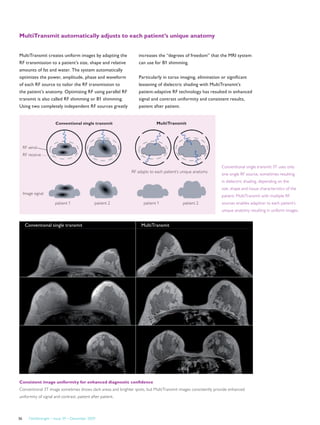 FieldStrength – Issue 39 – December 200936
Conventional single transmit MultiTransmit
Consistent image uniformity for enhanced diagnostic confidence
Conventional 3T image sometimes shows dark areas and brighter spots, but MultiTransmit images consistently provide enhanced
uniformity of signal and contrast, patient after patient.
MultiTransmit creates uniform images by adapting the
RF transmission to a patient’s size, shape and relative
amounts of fat and water. The system automatically
optimizes the power, amplitude, phase and waveform
of each RF source to tailor the RF transmission to
the patient’s anatomy. Optimizing RF using parallel RF
transmit is also called RF shimming or B1 shimming.
Using two completely independent RF sources greatly
patient 2patient 2
Image signal
RF send
RF receive
Conventional single transmit MultiTransmit
RF adapts to each patient’s unique anatomy
patient 1patient 1
Conventional single transmit 3T uses only
one single RF source, sometimes resulting
in dielectric shading, depending on the
size, shape and tissue characteristics of the
patient. MultiTransmit with multiple RF
sources enables adaption to each patient’s
unique anatomy resulting in uniform images.
increases the “degrees of freedom” that the MRI system
can use for B1 shimming.
Particularly in torso imaging, elimination or significant
lessening of dielectric shading with MultiTransmit’s
patient-adaptive RF technology has resulted in enhanced
signal and contrast uniformity and consistent results,
patient after patient.
MultiTransmit automatically adjusts to each patient’s unique anatomy
 