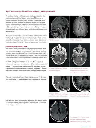 Tip 3: Overcoming T1-weighted imaging challenges with SE
T1-weighted imaging in infants presents challenges related to the
myelination process. Don’t expect to see good T1 contrast in
infants – regardless of field strength – as there is not enough white
matter in this stage. However, T1-weighted images still can reveal
hypoxic ischemic changes well before abnormalities become visible
in T2-weighted images. Hypoxic injury results in T1 signal changes in
the basal ganglia first, followed by the cerebral hemispheres in more
severe injuries.
Among T1 imaging methods, spin echo (SE) is still the gold standard.
In infants, SE images tend to be somewhat noisy, but this is normal,
especially in neonates, whose brains have ample water but minimal
myelin. By the age of three, SE T1 contrast approximates that of adults.
Controlling flow artifacts in SE
Flow artifacts in the posterior fossa have plagued post-contrast T1 SE
ever since contrast agents were introduced. Hyperintense, contrast-
enhanced blood flowing through the transverse sinuses causes bright
ghosting artifacts in the cerebellum. While this is seen in all patients, it
can be more severe in pediatric patients due to their higher heart rates.
Do NOT add a parallel REST slab to the scan. REST not only is
ineffective at suppressing contrast-enhanced flowing blood, but it also
reduces T1 contrast through the increased TR needed and through
Magnetization Transfer Contrast (MTC) effects. Using a REST slab also
may lead to increased motion artifacts due to longer overall scan time.
The only way to reduce flow artifacts in post-contrast T1 SE scans
is to use shortest TE combined with a flow compensation gradient.
T1 SE with REST shows reduced gray
matter/white matter differentiation.
Improved T1 contrast in image with
shortest TE and flow compensation.
This example of aT1TSE scan shows
poor gray matter/white matter
differentiation due largely to MTC effects.
T1W SE in neonate. T1W SE in 3-year-old.
T1 SE with a parallel REST. Arrows
indicate flow artifacts.
T1 SE with shortest TE and flow
compensation. Flow artifacts are
reduced as much as achievable.
Use of T1 TSE is not recommended as inherent MTC effects reduce
T1 contrast, and the pediatric patient’s inherently low T1 contrast
makes it a poor choice.
FieldStrength 39
 