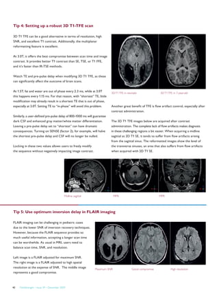 FieldStrength – Issue 39 – December 200940
Tip 4: Setting up a robust 3D T1-TFE scan
Tip 5: Use optimum inversion delay in FLAIR imaging
3D T1 TFE can be a good alternative in terms of resolution, high
SNR, and excellent T1 contrast. Additionally, the multiplanar
reformatting feature is excellent.
At 3.0T, it offers the best compromise between scan time and image
contrast. It provides better T1 contrast than SE, TSE, or T1 FFE,
and it’s faster than IR-TSE methods.
Watch TE and pre-pulse delay when modifying 3D T1 TFE, as these
can significantly affect the outcome of brain scans.
At 1.5T, fat and water are out of phase every 2.3 ms, while at 3.0T
this happens every 1.15 ms. For that reason, with “shortest” TE, little
modification may already result in a shortest TE that is out of phase,
especially at 3.0T. Setting TE to “in-phase” will avoid this problem.
Similarly, a user-defined pre-pulse delay of 800-1000 ms will guarantee
dark CSF and enhanced gray matter/white matter differentiation.
Leaving a pre-pulse delay set to “shortest” can have dramatic
consequences. Turning on SENSE (factor 2), for example, will halve
the shortest pre-pulse delay and CSF will no longer be nulled.
Locking in these two values allows users to freely modify
the sequence without negatively impacting image contrast.
FLAIR imaging can be challenging in pediatric cases
due to the lower SNR of inversion recovery techniques.
However, because the FLAIR sequence provides so
much useful information, accepting a longer scan time
can be worthwhile. As usual in MRI, users need to
balance scan time, SNR, and resolution.
Left image is a FLAIR adjusted for maximum SNR.
The right image is a FLAIR adjusted to high spatial
resolution at the expense of SNR. The middle image
represents a good compromise.
Another great benefit of TFE is flow artifact control, especially after
contrast administration.
The 3D T1 TFE images below are acquired after contrast
administration. The complete lack of flow artifacts makes diagnosis
in these challenging regions a bit easier. When acquiring a midline
sagittal as 2D T1 SE, it tends to suffer from flow artifacts arising
from the sagittal sinus. The reformatted images show the level of
the transverse sinuses, an area that also suffers from flow artifacts
when acquired with 2D T1 SE.
3DT1TFE in neonate 3DT1TFE in 7-year-old
Midline sagittal MPR MPR
Maximum SNR Good compromise High resolution
 