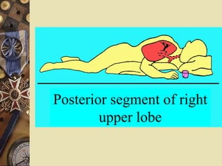 Posterior segment of right upper lobe 