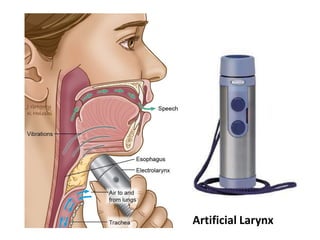 Artificial Larynx
 