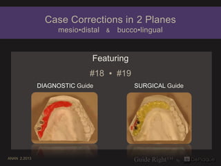 Case Corrections in 2 Planes
                    mesio▪distal   &   bucco▪lingual


                             Featuring
                             #18 ▪ #19
              DIAGNOSTIC Guide             SURGICAL Guide




ANAN 2.2013
 