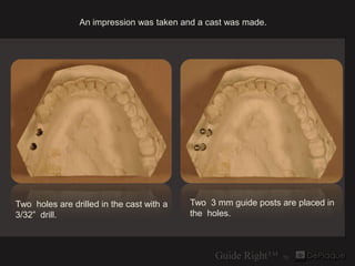 An impression was taken and a cast was made.




Two holes are drilled in the cast with a   Two 3 mm guide posts are place...