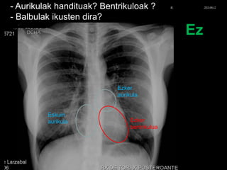 - Aurikulak handituak? Bentrikuloak ?
- Balbulak ikusten dira?
Ez
Eskuin
aurikula
Ezker
aurikula
Ezker
bentrikulua
© Xabier Zupiria, Andoni Bueno2013-06-12
 