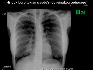 - Hilioak bere tokian daude? (eskuinekoa beherago)
Bai
© Xabier Zupiria, Andoni Bueno2013-06-12
 