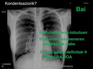 Kondentsaziorik?
Bai
Eskuineko erdi-lobuloan
Birikaren bolumenaren
aldaketarik gabe
Ertzak gaizki definitak
INFILTRAZIOA
© Xabier Zupiria, Andoni Bueno2013-06-12
 
