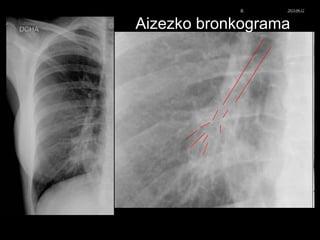 Aizezko bronkograma
© Xabier Zupiria, Andoni Bueno2013-06-12
 