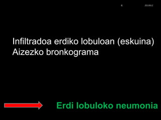 Infiltradoa erdiko lobuloan (eskuina)
Aizezko bronkograma
Erdi lobuloko neumonia
© Xabier Zupiria, Andoni Bueno2013-06-12
 