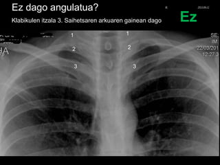 Ez dago angulatua?
Klabikulen itzala 3. Saihetsaren arkuaren gainean dago
1
2
3
1
2
3
Ez
© Xabier Zupiria, Andoni Bueno2013-06-12
 