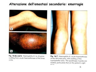 Alterazione dell’emostasi secondaria: emorragie




                                            31
 