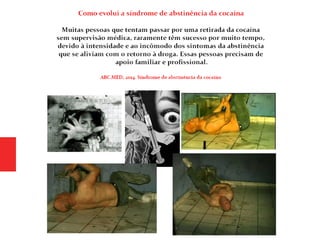 Psiquiatria - Cocaína (Coca, pó, branquinha)