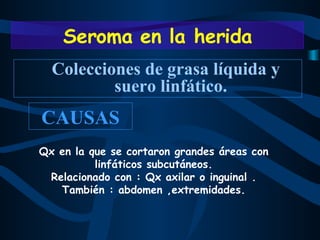 Colecciones de grasa líquida y suero linfático. CAUSAS Qx en la que se cortaron grandes áreas con linfáticos subcutáneos. Relacionado con : Qx axilar o inguinal . También : abdomen ,extremidades. Seroma en la herida 