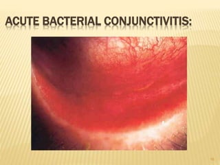 16
ACUTE BACTERIAL CONJUNCTIVITIS:
 