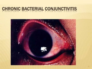 17
CHRONIC BACTERIAL CONJUNCTIVITIS
 