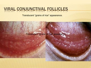 VIRAL CONJUNCTIVAL FOLLICLES
Translucent “grains of rice” appearance.
Translucent “grains of rice” appearance.
 