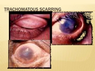 TRACHOMATOUS SCARRING
 