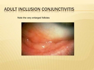 ADULT INCLUSION CONJUNCTIVITIS
Note the very enlarged follicles
 