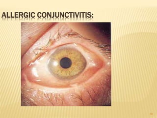 59
ALLERGIC CONJUNCTIVITIS:
 