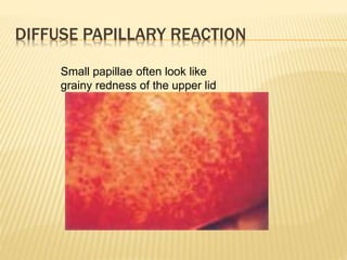 DIFFUSE PAPILLARY REACTION
Small papillae often look like
grainy redness of the upper lid
 